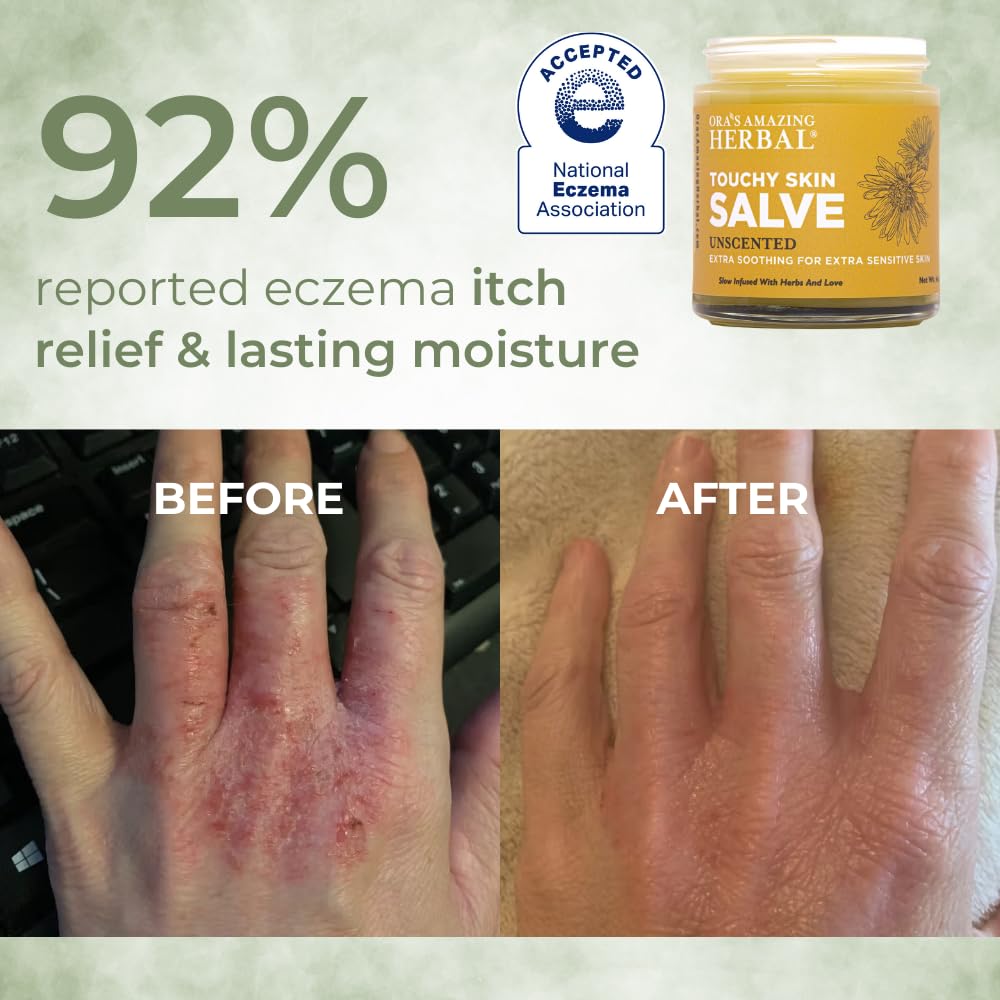 touchy-skin-salve-eczema-cream-for-kids--3.jpg