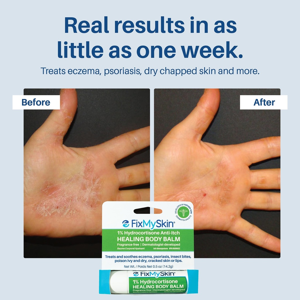 fixmyskin-1-hydrocortisone-healing-body--5.jpg
