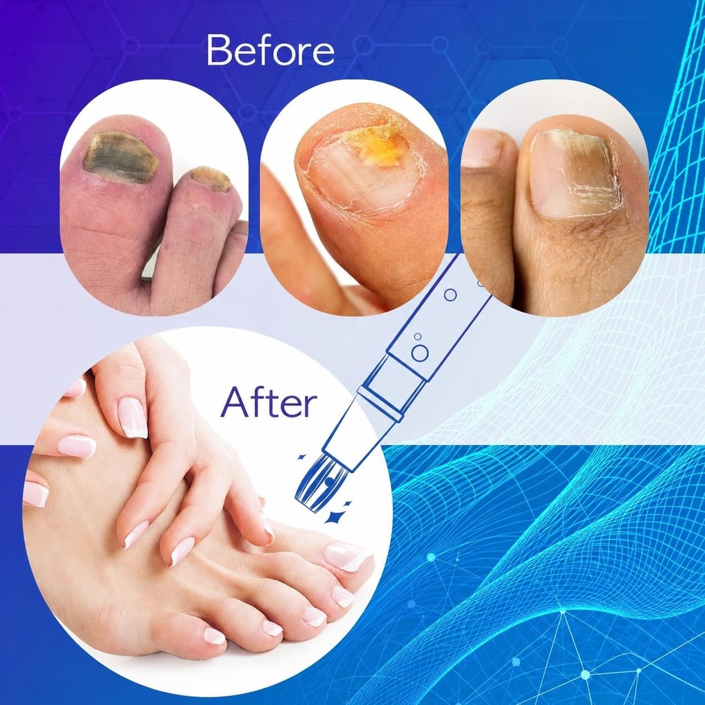 fungal-nail-pen-toenail-fungus-pen-nail--5.jpg