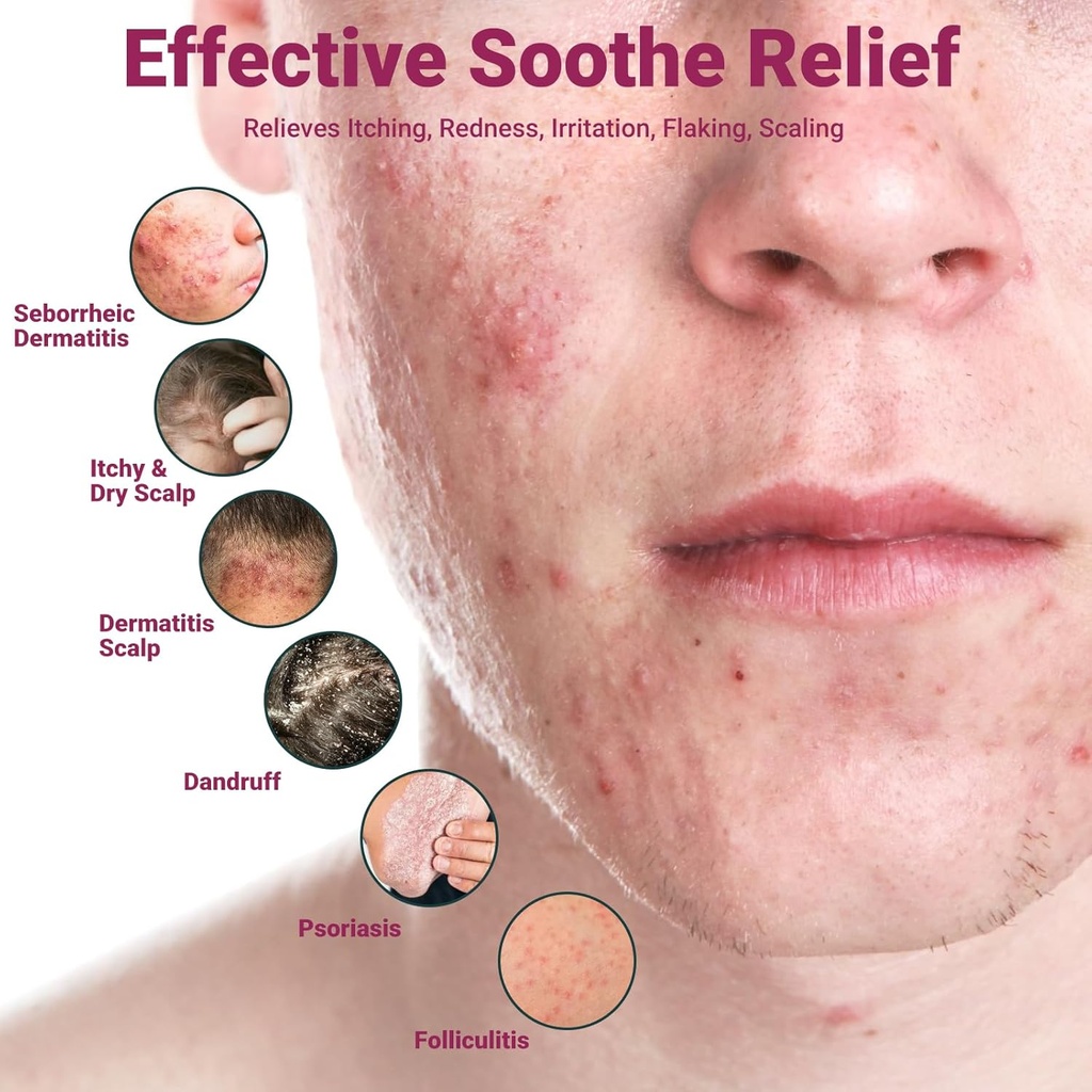 ishancare-seborrheic-dermatitis-cream-ma-3.jpg