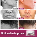 ishancare-seborrheic-dermatitis-cream-ma-6.jpg