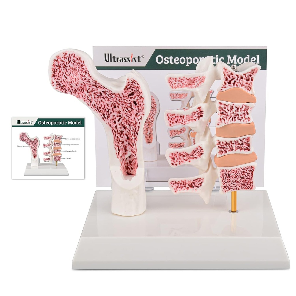 Ultrassist Človeška anatomija Osteoporoza Model, Vertebrae Anatomski okostje Model s študijsko kartico za medicinsko študentsko poučevanje Demonstracija